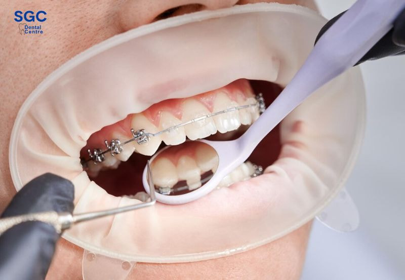 Niềng răng vẫn trồng răng Implant được nhưng cần lưu ý nhiều điều