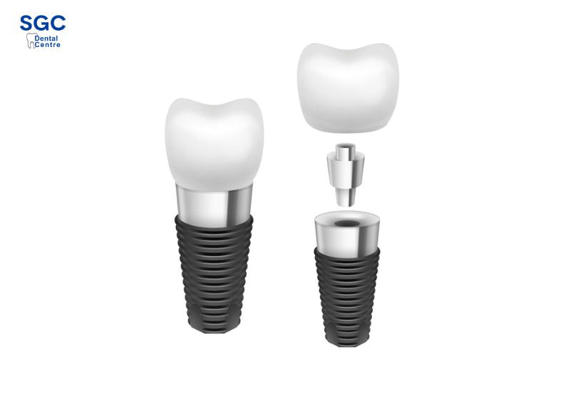 Nên niềng răng trước khi cấy ghép Implant