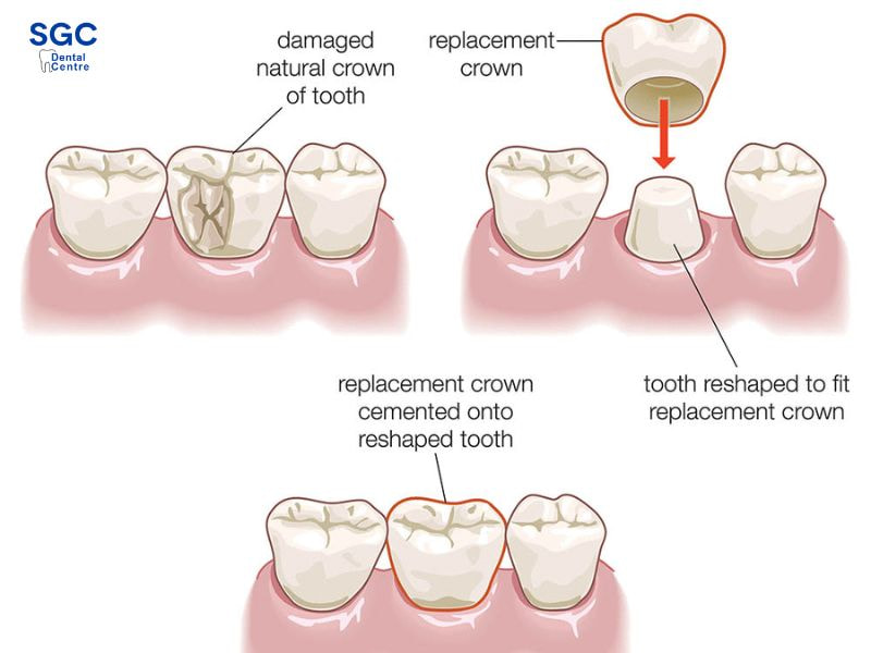 Răng có mảng vỡ lớn nên bọc sứ để bảo vệ răng