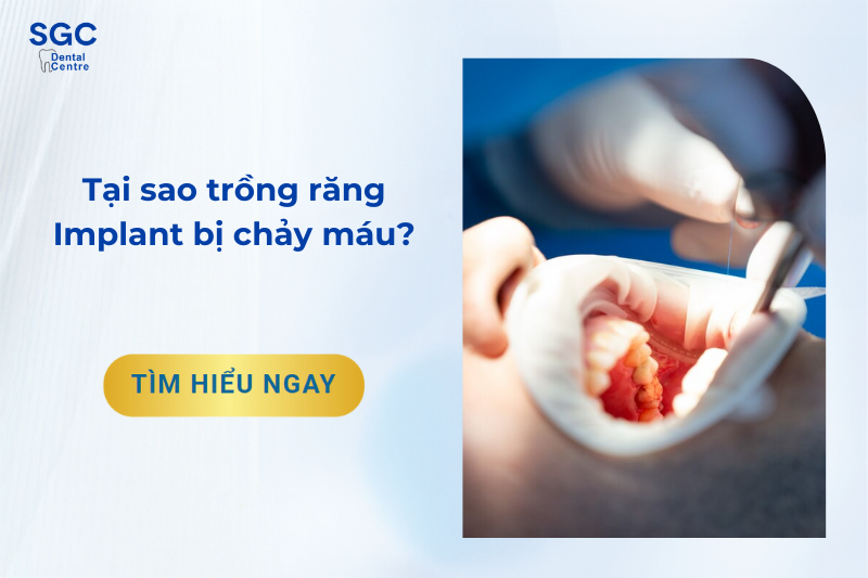 Nguyên nhân trồng răng Implant bị chảy máu và cách chăm sóc?