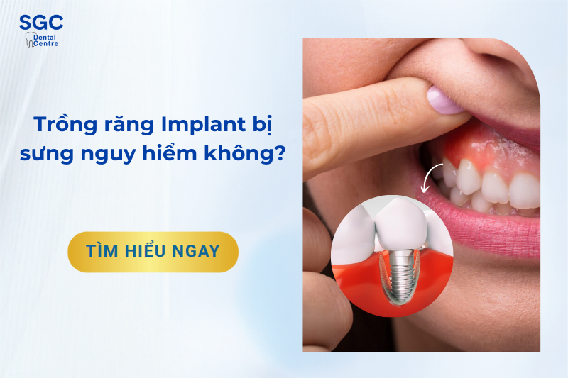 Trồng răng Implant bị sưng do đâu, có nguy hiểm không?