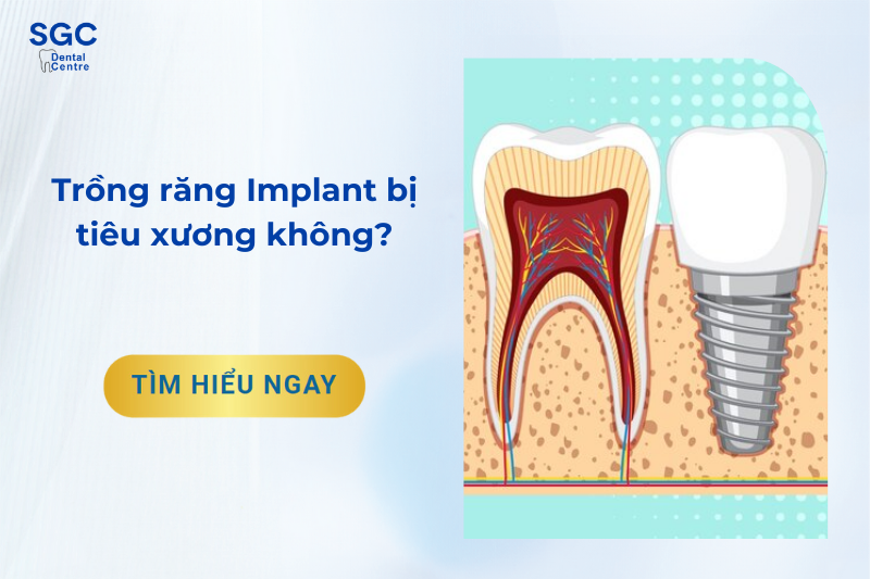 Trồng răng Implant bị tiêu xương không? Các cách khắc phục?