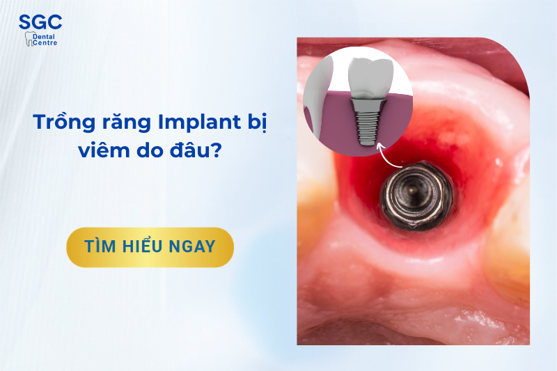 Trồng răng Implant bị viêm do đâu?