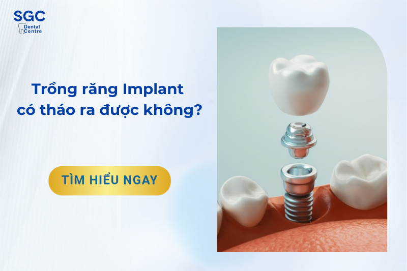 Trồng răng Implant có tháo ra được không?