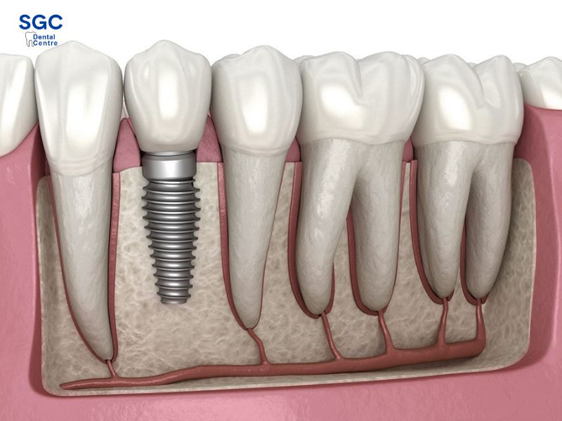 Trồng răng Implant giúp khôi phục răng mất hiệu quả