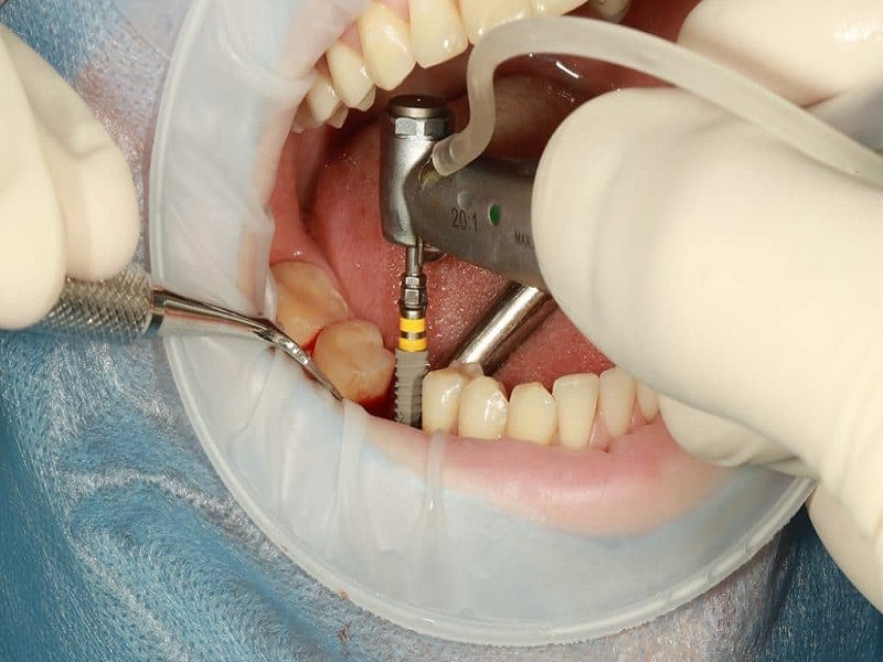 Trồng răng Implant không phù hợp với người dưới 18 tuổi