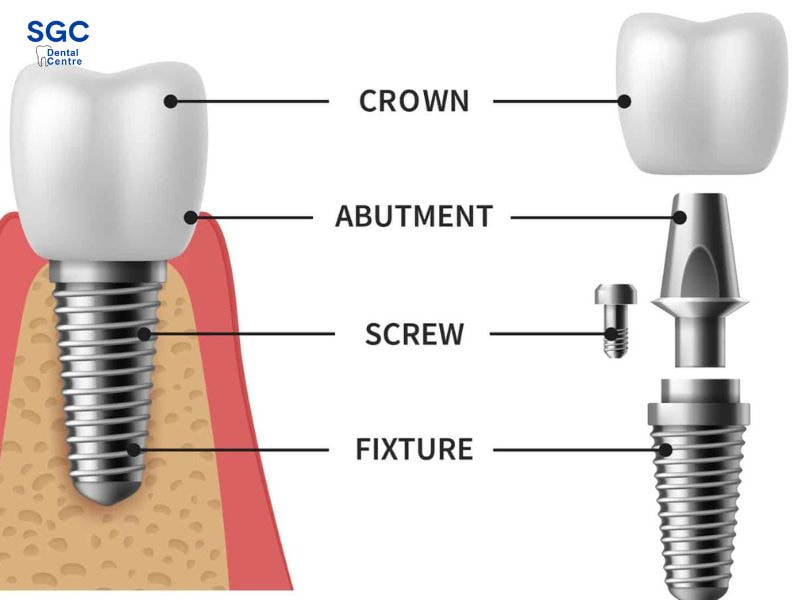 Vật liệu răng Implant phải đạt yêu cầu cao về chất lượng