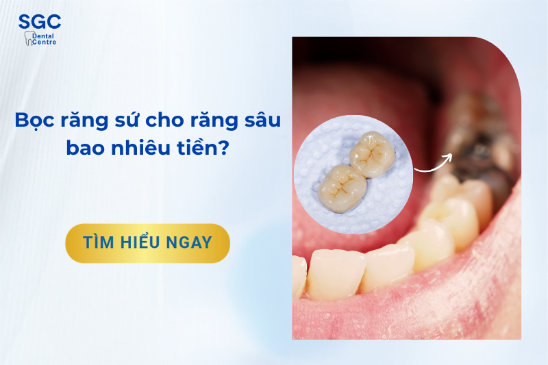 Chi phí bọc răng sứ cho răng sâu bao nhiêu tiền