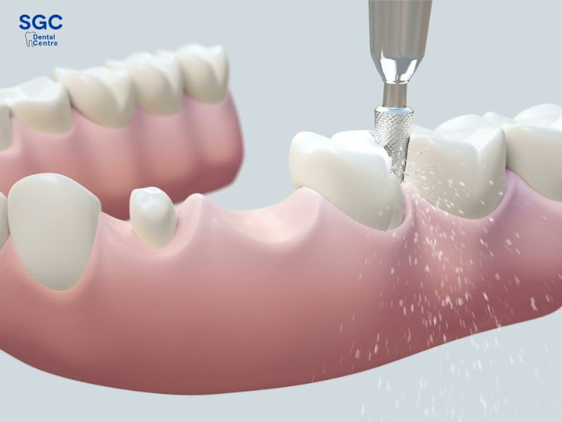 Bọc răng sứ giá rẻ có thể làm hỏng răng thật của bạn