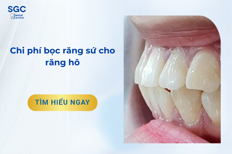 Chi phí bọc răng sứ cho răng hô hết bao nhiêu