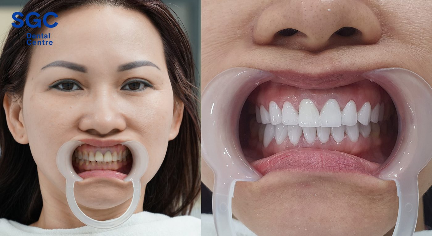 Hình ảnh trước và sau khi bọc răng sứ tại Nha Khoa SGC