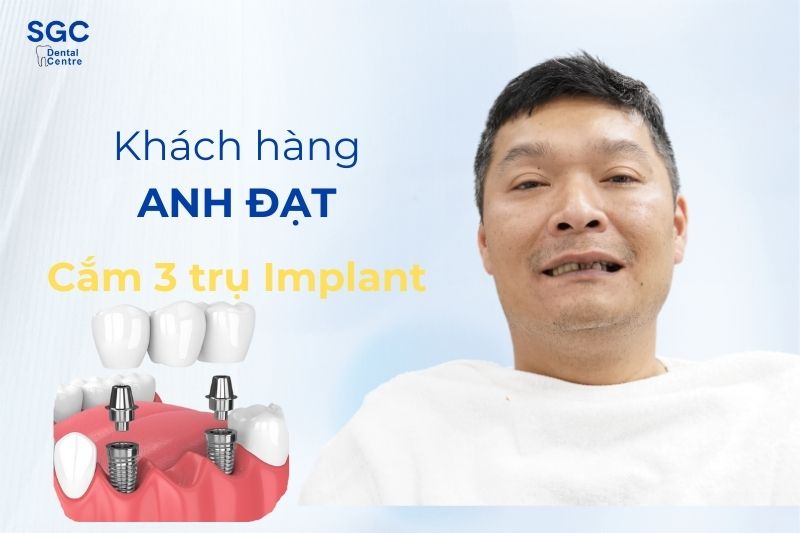 Khách hàng anh Đạt với dịch vụ trồng răng Implant