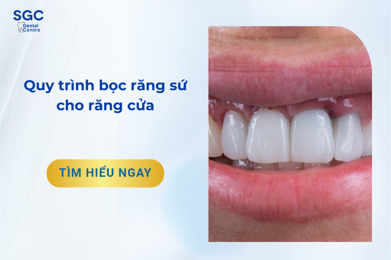 Quy trình bọc răng sứ cho răng cửa