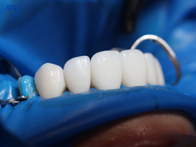 Răng sứ cần đảm bảo chất lượng để có kết quả tốt