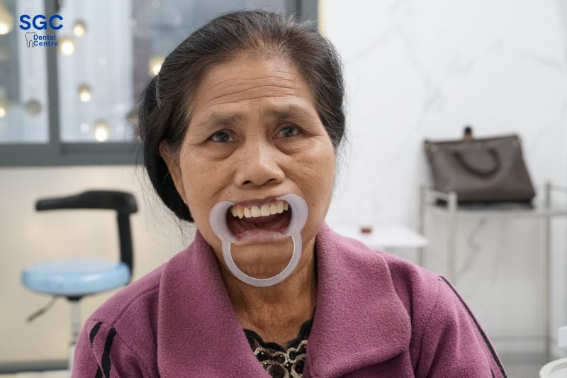 Trồng răng Implant nguyên hàm dưới giá dao động chỉ từ 100 triệu