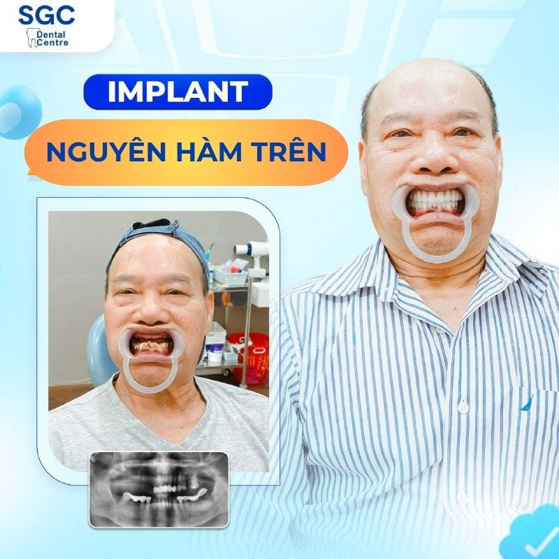 Giá trồng răng Implant nguyên hàm trên phụ thuộc vào mỗi khách hàng