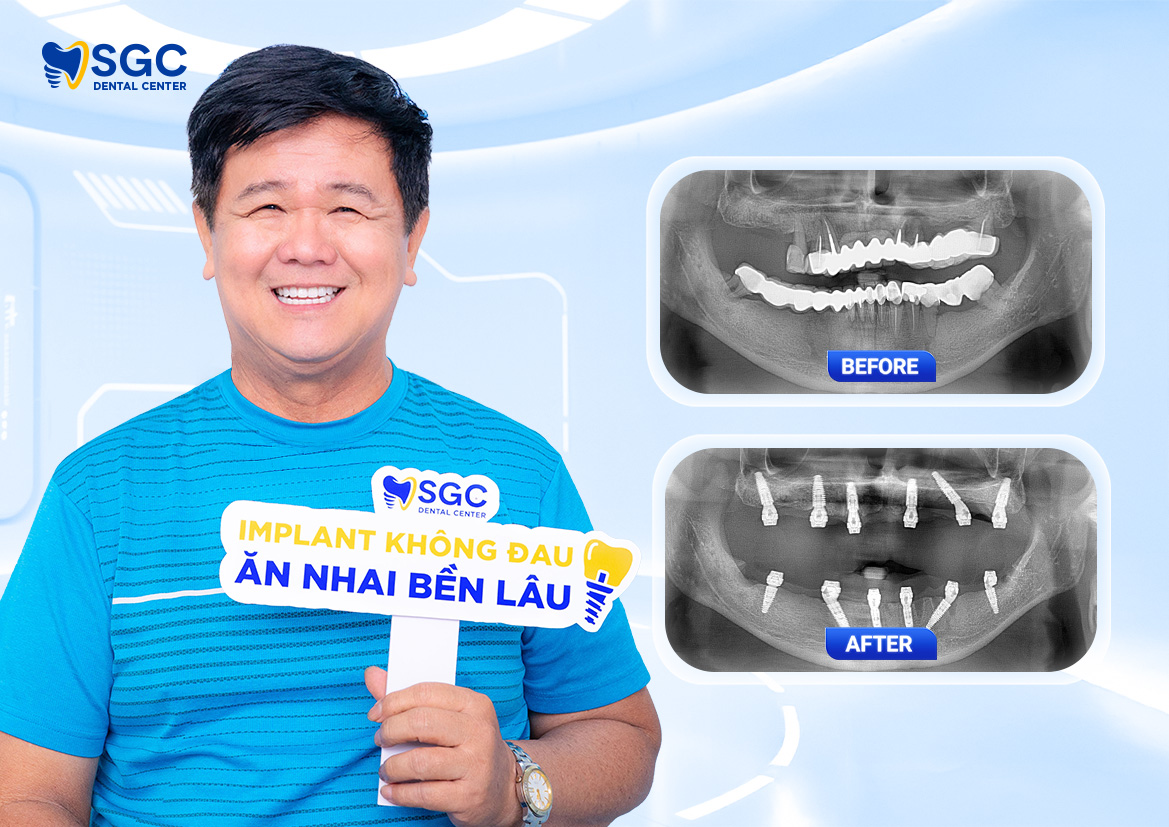 Trồng răng Implant là gì? Giải đáp chi tiết từ A đến Z 15 WEB BF AF 1