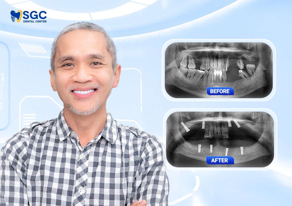 Trồng răng Implant là gì? Giải đáp chi tiết từ A đến Z 13 WEB BF AF 2