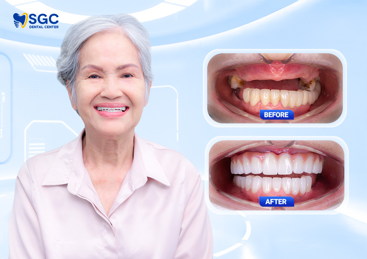 Trồng răng Implant là gì? Giải đáp chi tiết từ A đến Z 4 WEB BF AF 3