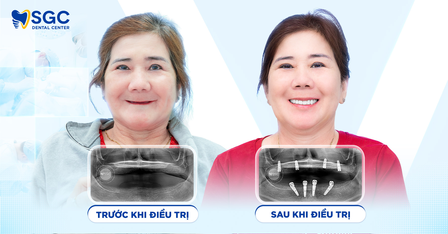 Trồng răng Implant là gì? Giải đáp chi tiết từ A đến Z 7 WEB BFAF