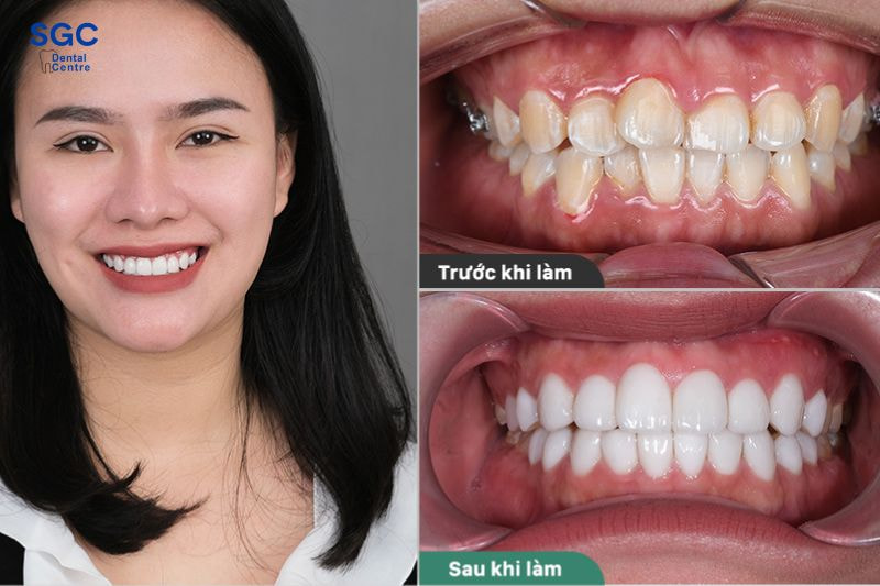 Bọc răng sứ cải thiện các khuyết điểm răng miệng khi mang thai