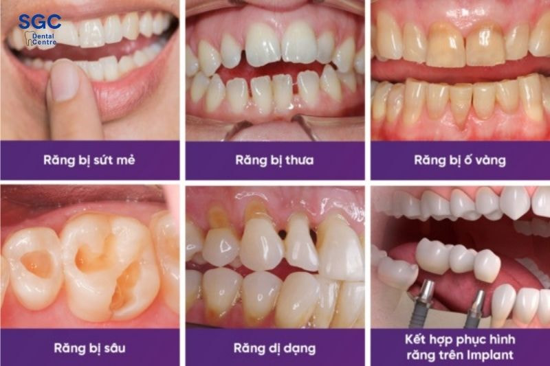 Bọc răng toàn sứ Ceramill giúp cải thiện các khuyết điểm răng miệng