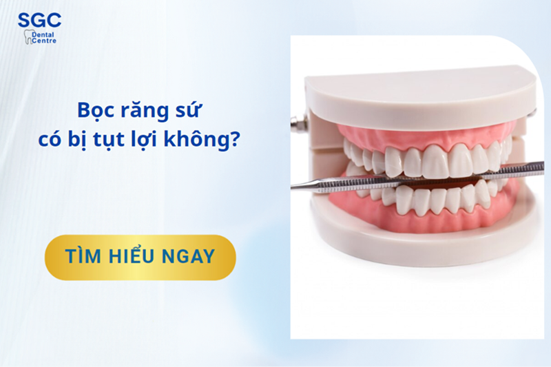 Bọc răng sứ có bị tụt lợi không? Nguyên nhân và giải pháp