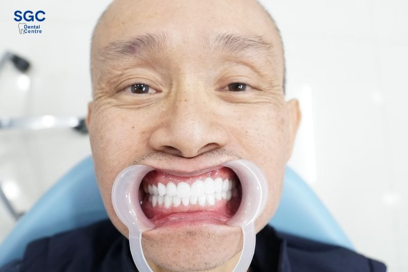 Bọc sứ Ceramill giúp hạn chế các biến chứng hôi miệng, sâu răng