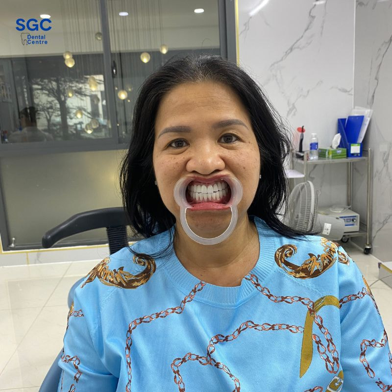 Bọc sứ Zirconia giúp giữ tối đa cấu trúc răng thật, hạn chế mài mòn