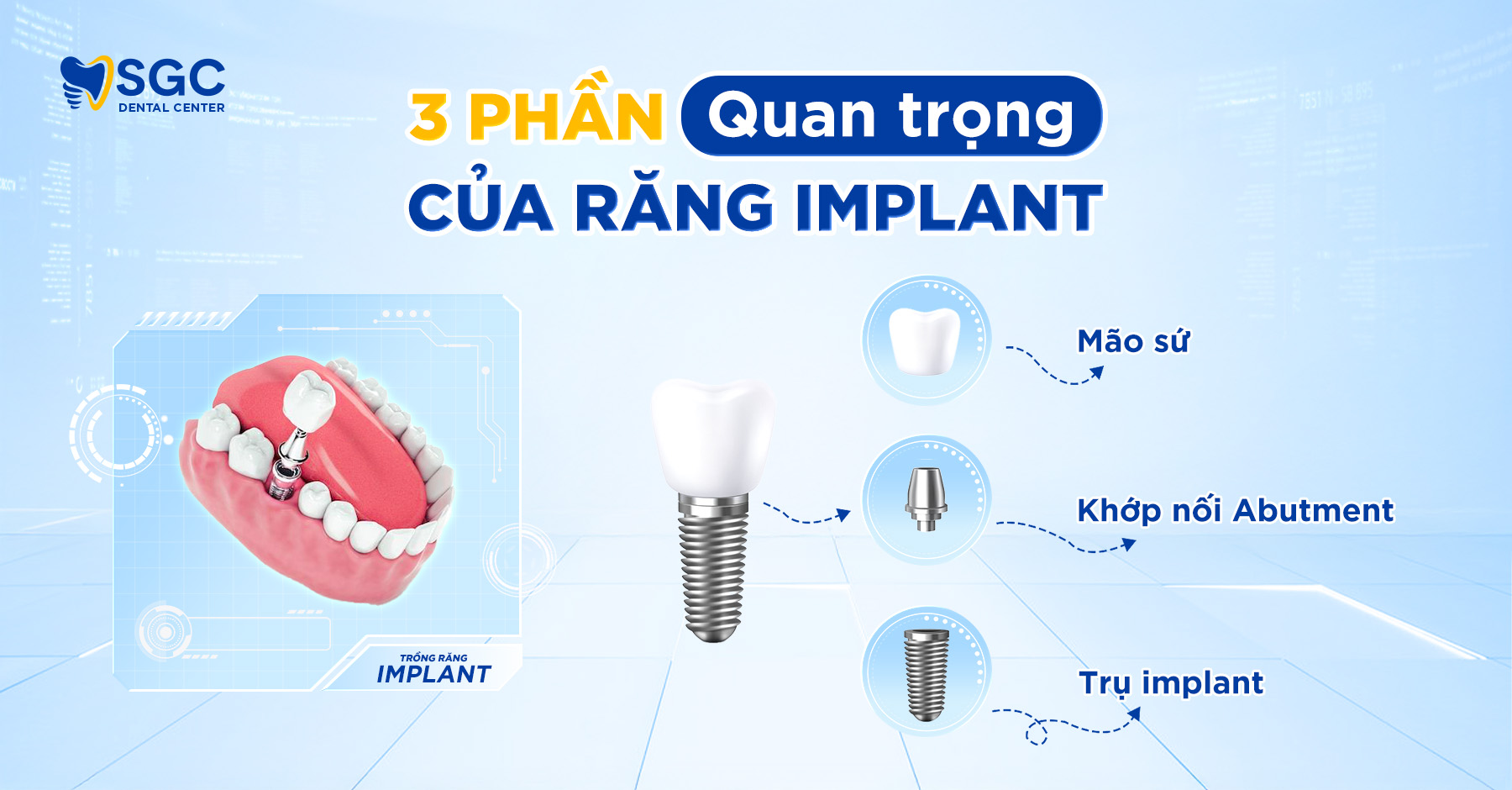 Trồng răng Implant là gì? Giải đáp chi tiết từ A đến Z 2 cau tao rang su 3