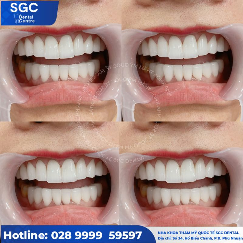 Hàm răng chị Đào Nguyễn đã được cải thiện sau khi bọc sứ tại Nha khoa SGC