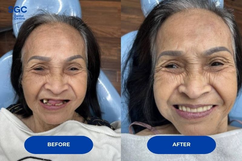 Hình ảnh khách hàng trước - sau khi trồng răng Implant All On 4