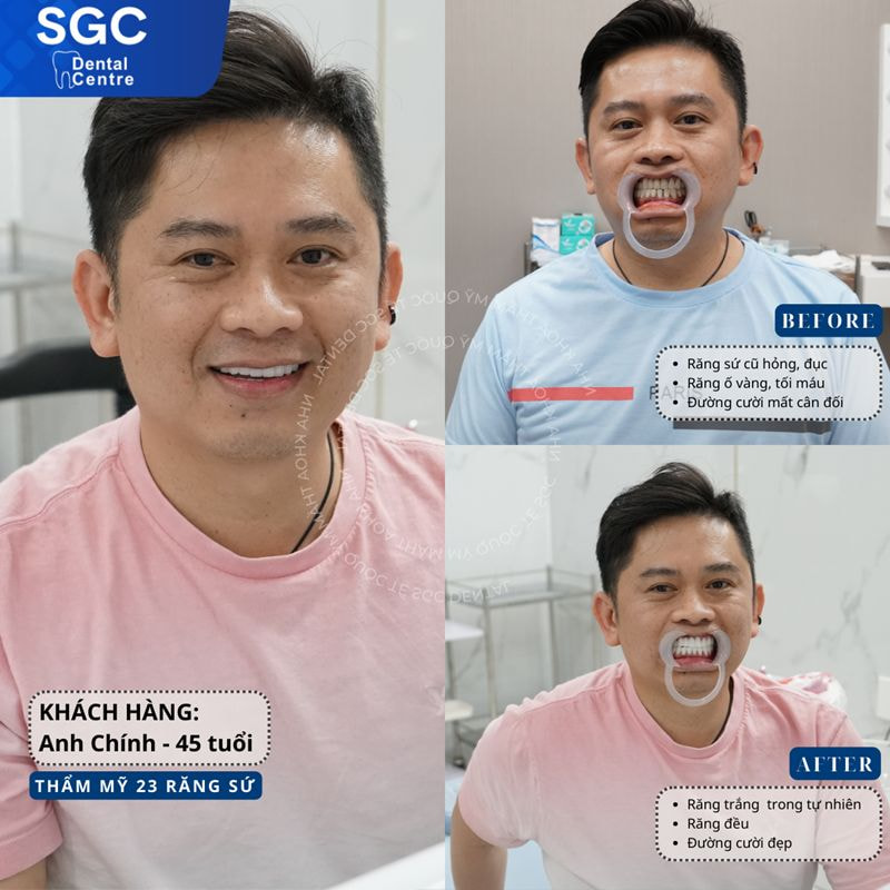 Hình ảnh khách hàng đã bọc răng sứ tại Nha khoa SGC