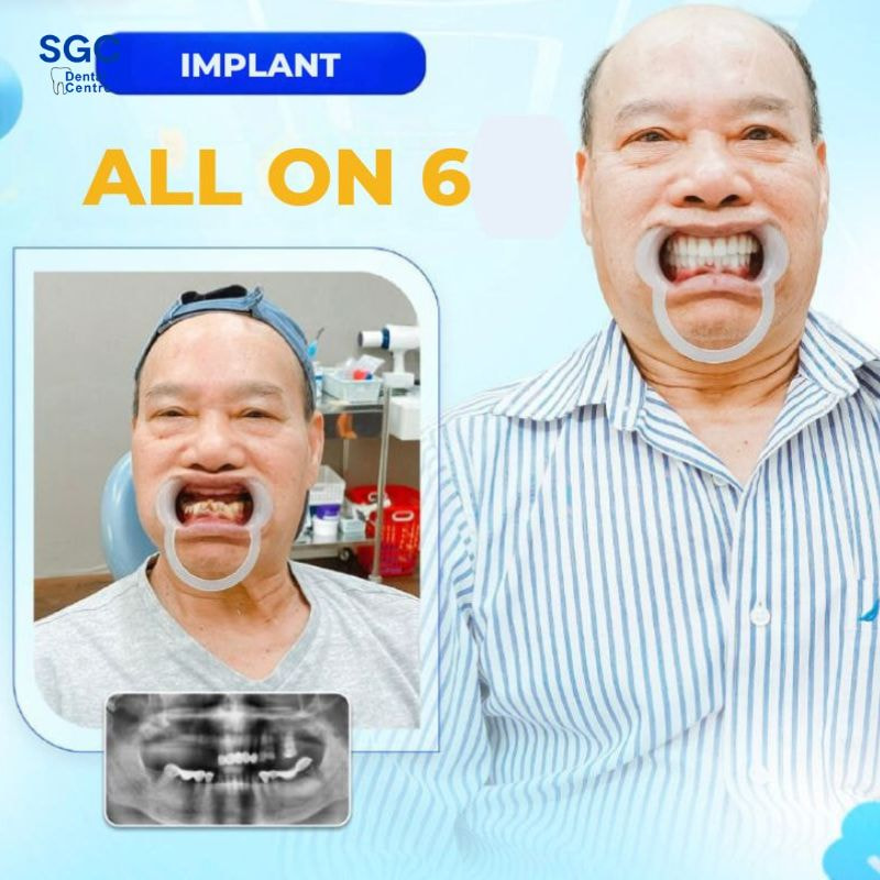 Khách hàng đánh giá cao về hiệu quả đem lại khi trồng răng Implant All On 6