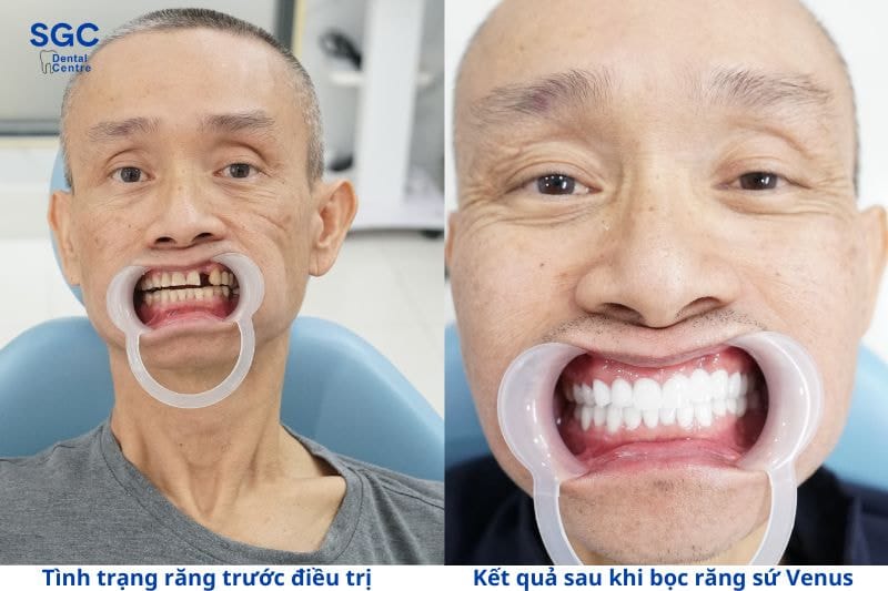Bọc răng sứ Venus có tốt không? Có mấy loại? Giá bao nhiêu? 8 Khách hàng hài lòng thực hiện bọc sứ tại Nha khoa SGC