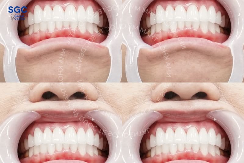 Bọc răng sứ Venus có tốt không? Có mấy loại? Giá bao nhiêu? 5 Nên bọc sứ Venus hay không phụ thuộc vào tài chính mỗi người