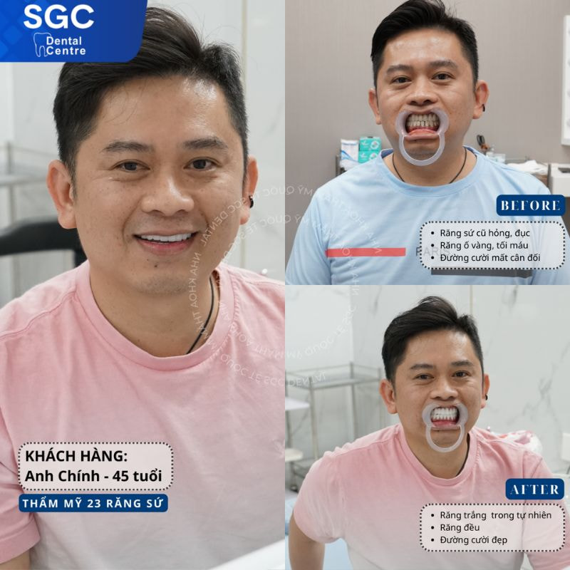 Nha khoa SGC thành công cải thiện mọi khuyết điểm trên răng cho anh Chính