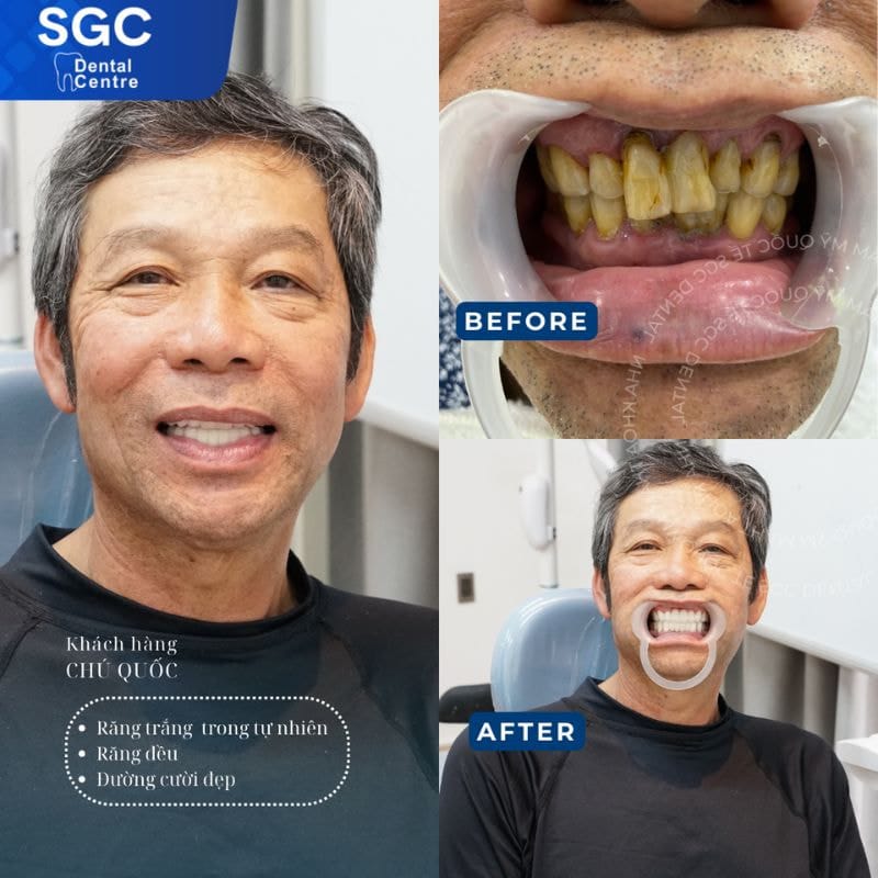 Bọc răng sứ Venus có tốt không? Có mấy loại? Giá bao nhiêu? 3 Răng bị ố vàng nên bọc răng sứ để cải thiện khuyết điểm