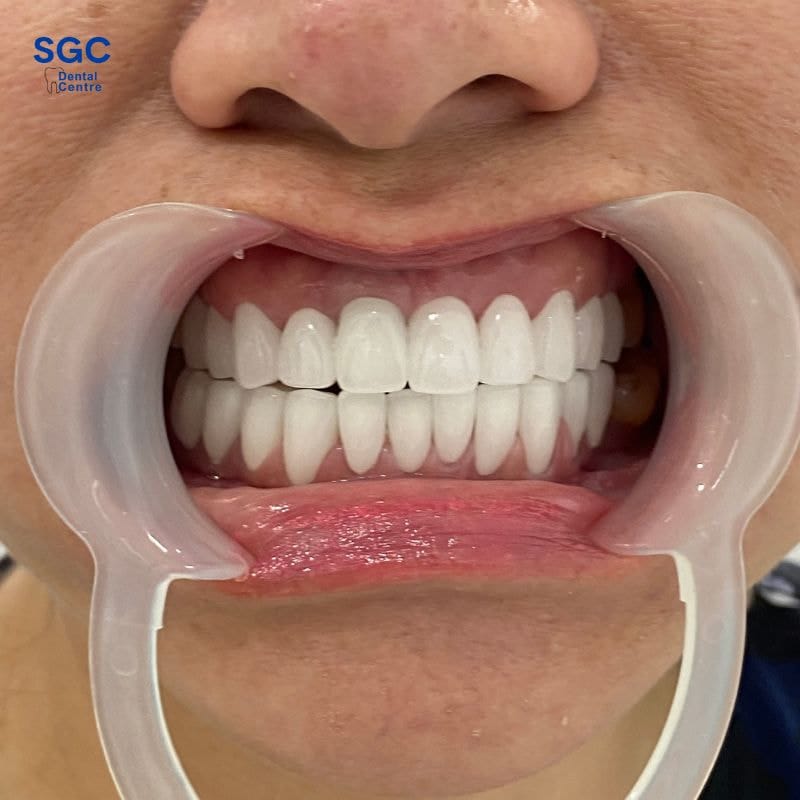 Bọc răng sứ Venus có tốt không? Có mấy loại? Giá bao nhiêu? 2 Răng toàn sứ Venus của Đức được đánh giá cao về chất lượng