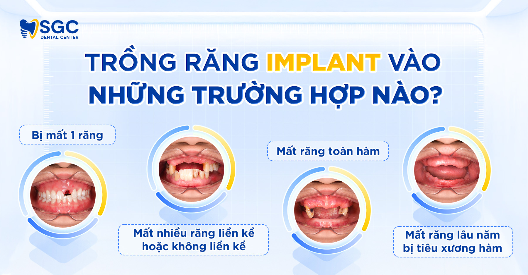 Trồng răng Implant là gì? Giải đáp chi tiết từ A đến Z 6 trong rang implant
