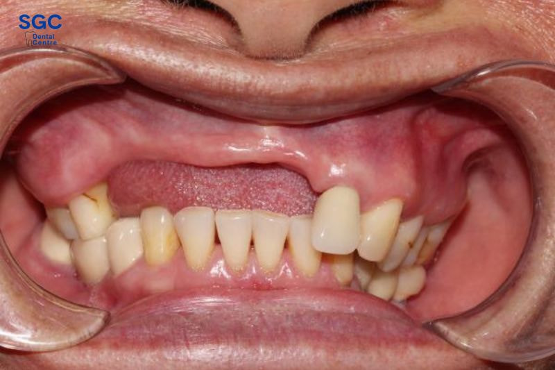 Xương hàm bị tiêu lõm nếu như để tình trạng mất răng kéo dài