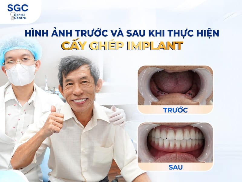 Cải thiện tình trạng mất răng toàn hàm bằng công nghệ Implant All On 4