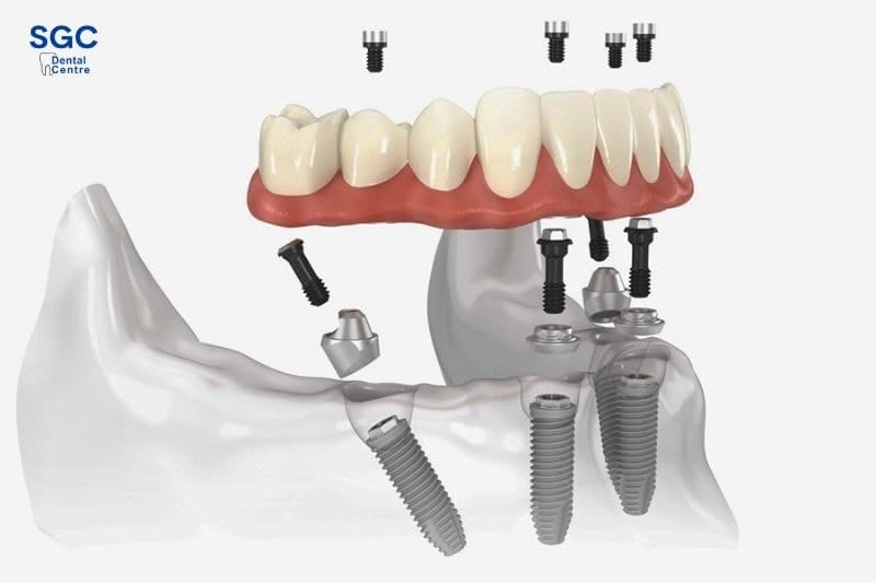 Trụ Implant Straumann Thụy Sĩ: Xuất xứ, ưu điểm và giá cả 2 Cấy ghép trụ Straumann đem lại khả năng tích hợp xương nhanh chóng chỉ trong 6 tuần