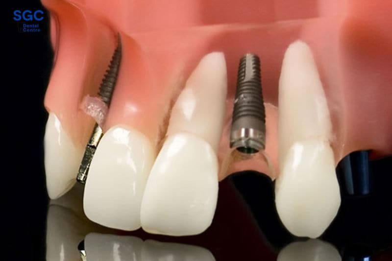 Giá trồng răng Implant phụ thuộc vào loại và số lượng trụ