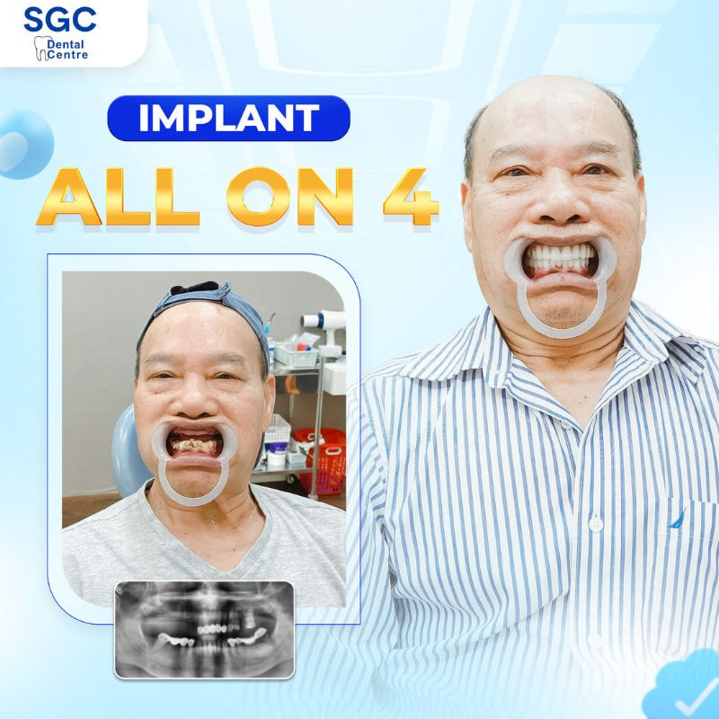 Hình ảnh khách hàng trước và sau khi thực hiện trồng Implant toàn hàm Biotem