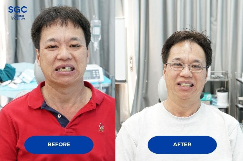 Khách hàng luôn hài lòng với kết quả đem lại sau khi trồng Implant Hàn Quốc