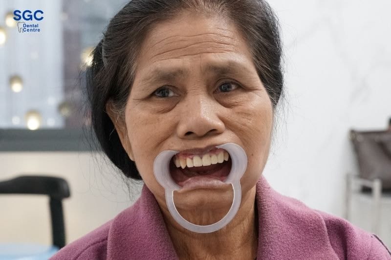 Trụ Implant Hiossen: Xuất xứ, ưu điểm, hạn chế và giá cả 5 Nên trồng trụ Hiossen Mỹ trong trường hợp mất răng toàn hàm