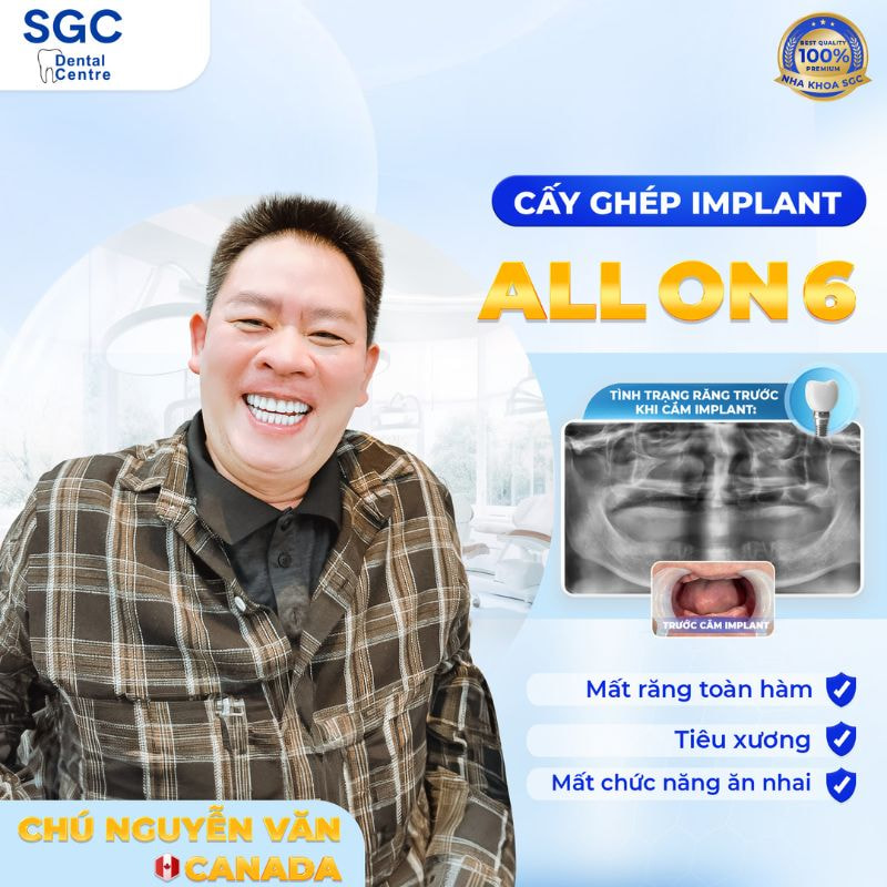 Nha khoa SGC thực hiện cấy ghép toàn hàm thành công cho chú Nguyễn Văn