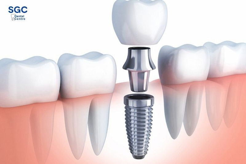 Thiết kế thông minh của trụ Hiossen giúp giảm thiểu các tổn thương lên cấu trúc răng