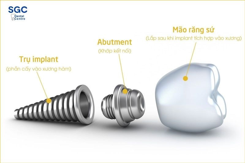 Trụ Implant Mỹ được làm từ Titanium nguyên chất